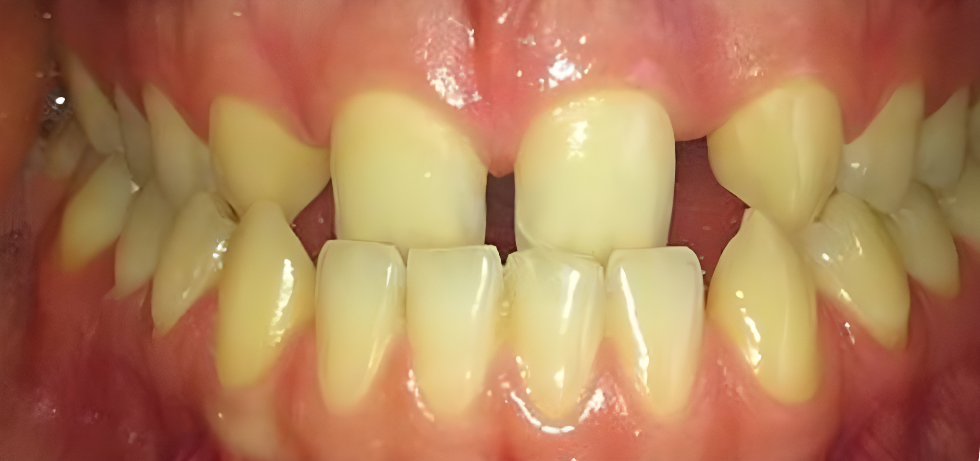 Antes do tratamento- Ortodontia